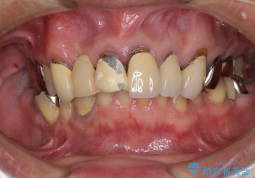 欠けてしまった前歯のブリッジをオールセラミックブリッジへの治療前