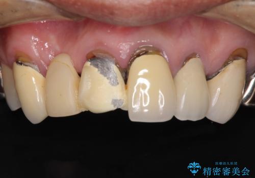 欠けてしまった前歯のブリッジをオールセラミックブリッジへの治療前