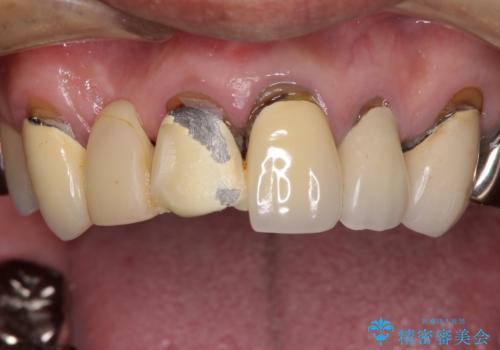 欠けてしまった前歯のブリッジをオールセラミックブリッジへの治療前