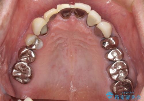 欠けてしまった前歯のブリッジをオールセラミックブリッジへの治療前
