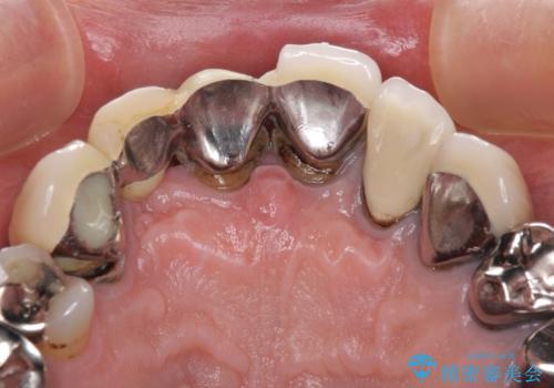 欠けてしまった前歯のブリッジをオールセラミックブリッジへの治療前