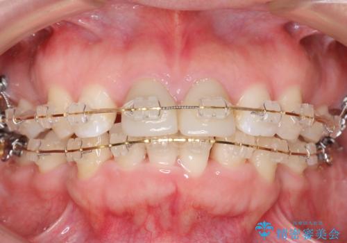 口ゴボでお悩みの方必見! 不自然なセラミックをやり直す矯正 セラミックだけでは、口元は下がりません。の治療中