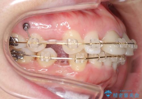 口ゴボでお悩みの方必見! 不自然なセラミックをやり直す矯正 セラミックだけでは、口元は下がりません。の治療中