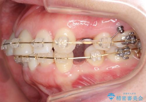 口ゴボでお悩みの方必見! 不自然なセラミックをやり直す矯正 セラミックだけでは、口元は下がりません。の治療中