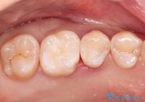 セラミックインレー メタルフリーの治療の症例 治療後