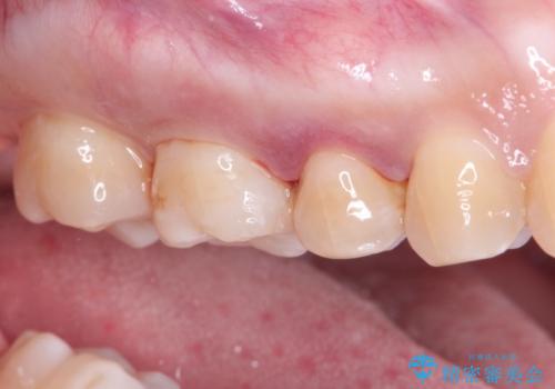 セラミックインレー メタルフリーの治療の治療後