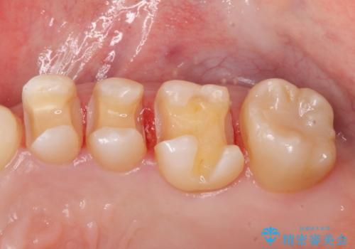 3本仮づめのまま放置 セラミックインレーへの治療中