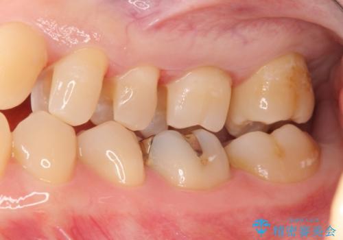 3本仮づめのまま放置 セラミックインレーへの治療中