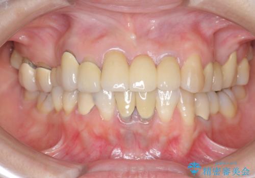 前歯ブリッジのやりかえの治療後