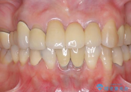 前歯ブリッジのやりかえの治療後