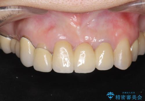 前歯ブリッジのやりかえ