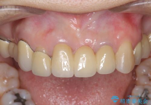 前歯ブリッジのやりかえの治療後