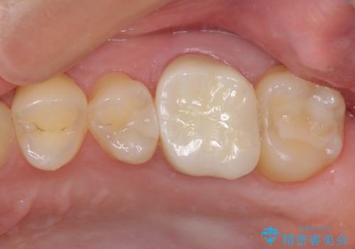 奥歯のむし歯治療 セラミックとゴールドインレーの治療後