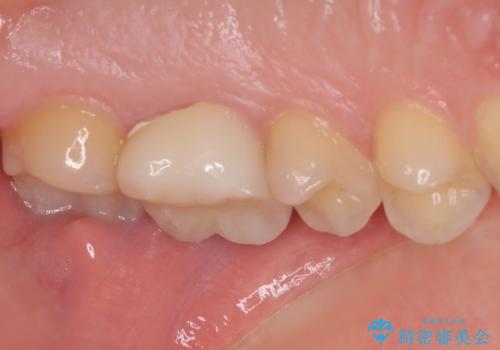 奥歯のむし歯治療 セラミックとゴールドインレーの治療後