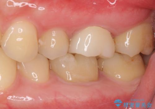 奥歯のむし歯治療 セラミックとゴールドインレーの治療後
