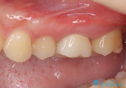 奥歯のむし歯治療 セラミックとゴールドインレーの治療後