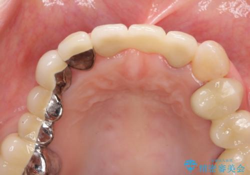 前歯ブリッジのやりかえの治療後