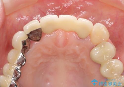 前歯ブリッジのやりかえの治療後