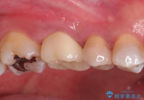 奥歯の根管治療~オールセラミッククラウンの治療後