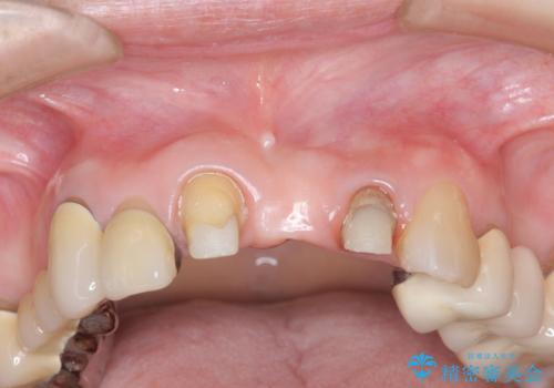 前歯ブリッジのやりかえの治療前