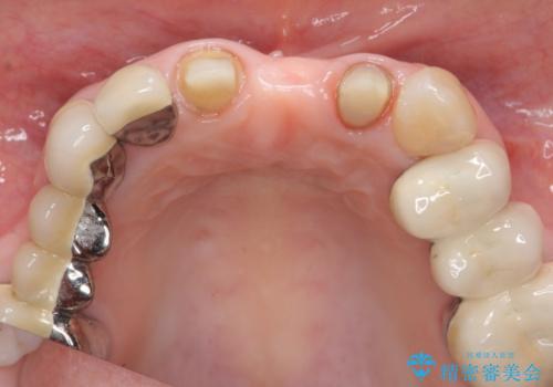 前歯ブリッジのやりかえの治療後
