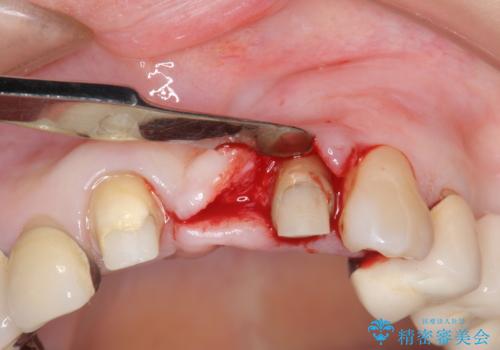 前歯ブリッジのやりかえの治療中