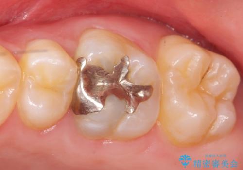 オールセラミッククラウン ズキズキ痛む歯の治療の治療前