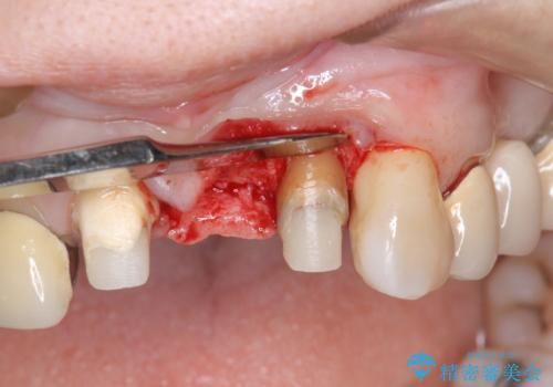 前歯ブリッジのやりかえの治療中