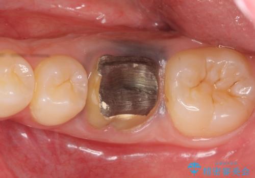 オールセラミッククラウン 治療途中の歯の再治療の治療前