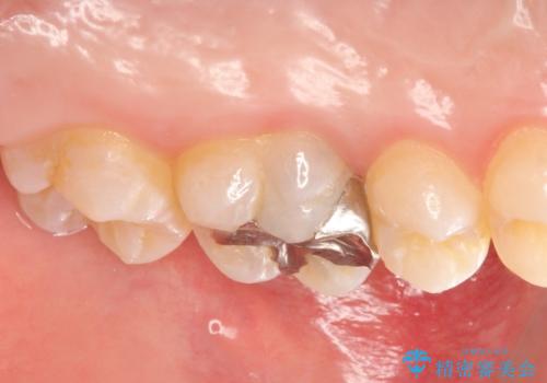 オールセラミッククラウン ズキズキ痛む歯の治療の治療前