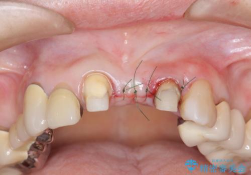 前歯ブリッジのやりかえの治療前