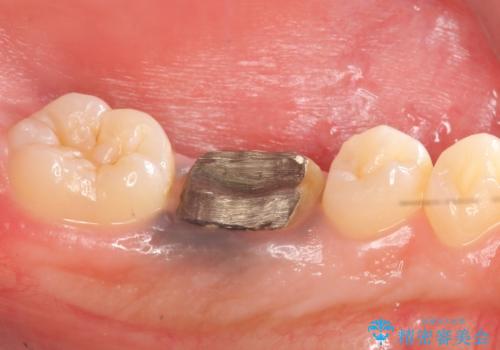 オールセラミッククラウン 治療途中の歯の再治療の治療前