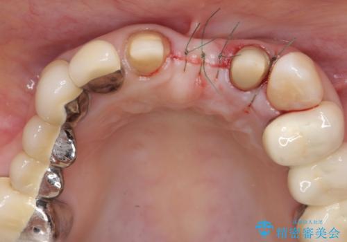 前歯ブリッジのやりかえの治療後