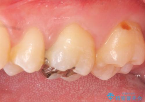 オールセラミッククラウン ズキズキ痛む歯の治療の治療前