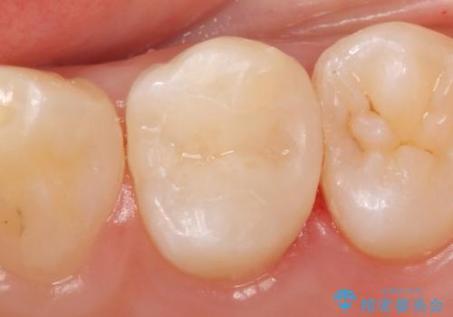 セラミックインレー　虫歯で欠けた歯の治療の症例 治療後