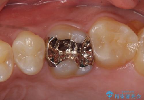 セラミックインレー 虫歯と指摘された奥歯の治療の症例 治療後