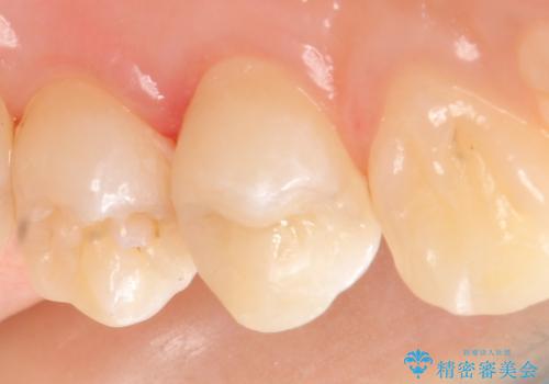 セラミックインレー 虫歯で欠けた歯の治療の治療後