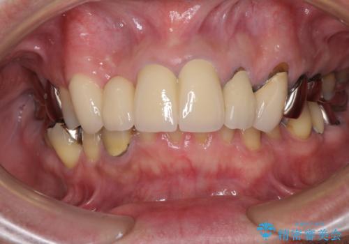 欠けてしまった前歯のブリッジをオールセラミックブリッジへの治療後