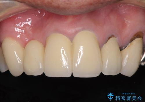 欠けてしまった前歯のブリッジをオールセラミックブリッジへの治療後
