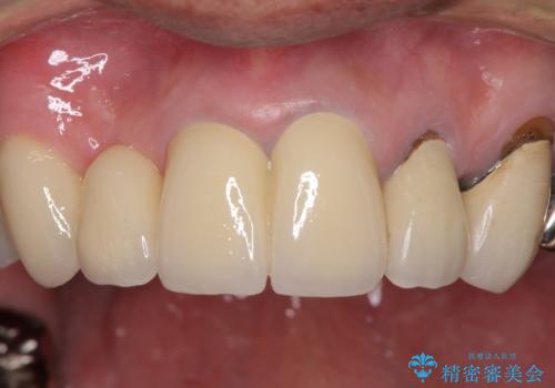 欠けてしまった前歯のブリッジをオールセラミックブリッジへの治療後
