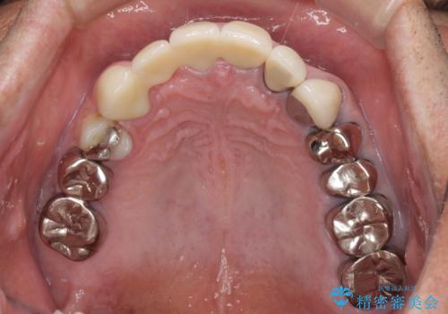 欠けてしまった前歯のブリッジをオールセラミックブリッジへの治療後