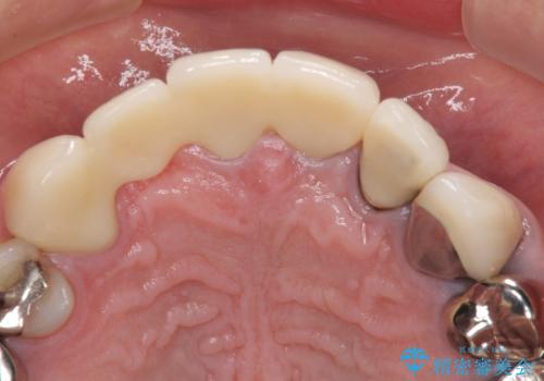 欠けてしまった前歯のブリッジをオールセラミックブリッジへの治療後