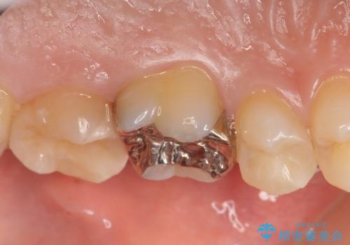 セラミックインレー　虫歯と指摘された奥歯の治療の治療後