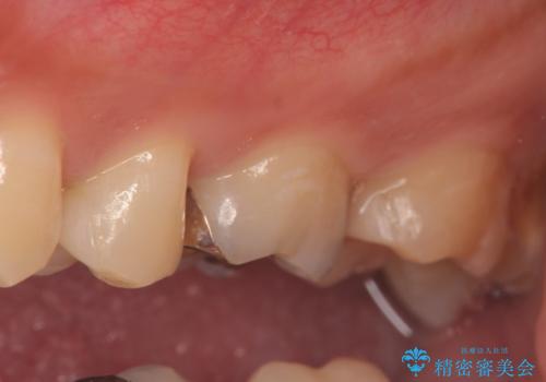 セラミックインレー 虫歯と指摘された奥歯の治療の治療後