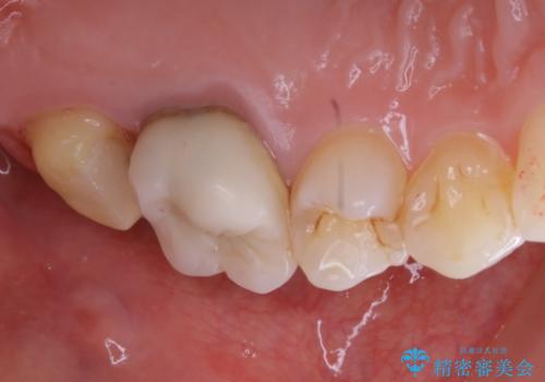 痛みの続いた歯を原因から治療の治療中