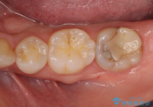 他院で次に虫歯になったら治せないと言われた　歯周外科手術でしっかり治療(APF)の治療前