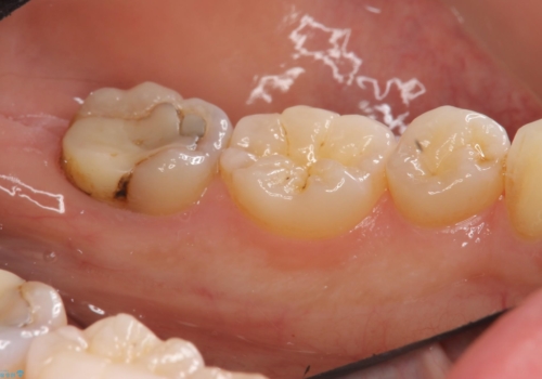 他院で次に虫歯になったら治せないと言われた　歯周外科手術でしっかり治療(APF)の治療前
