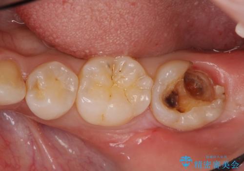 他院で次に虫歯になったら治せないと言われた 歯周外科手術でしっかり治療(APF)の治療前
