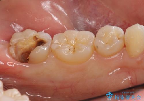 他院で次に虫歯になったら治せないと言われた　歯周外科手術でしっかり治療(APF)の症例 治療前