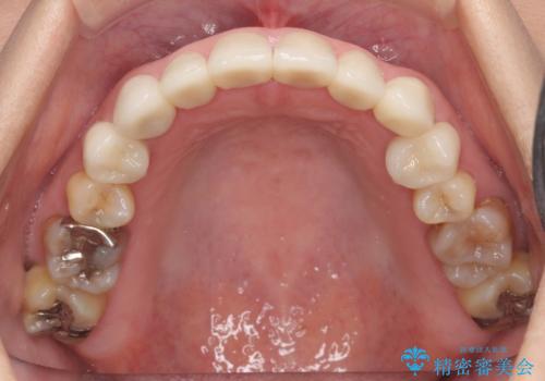 オールセラミッククラウン・セラミックインレー 口腔内全体の見た目の改善の治療後